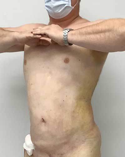 male liposuction in miami after