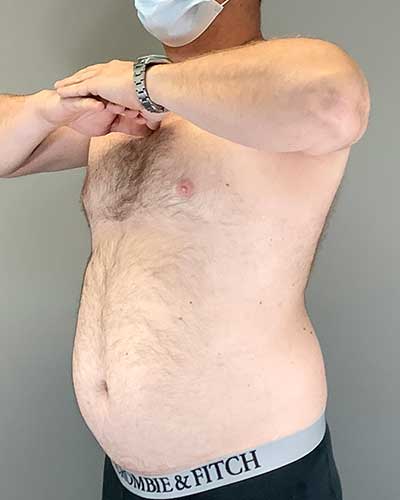 male liposuction in miami before