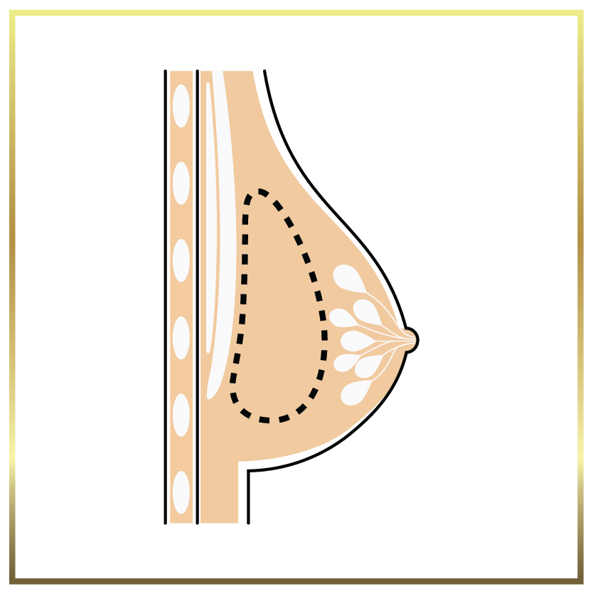 subglandular breast implant