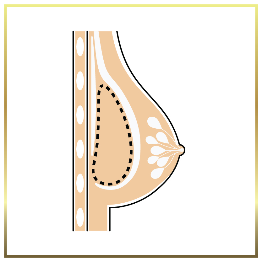 submuscular breast implant